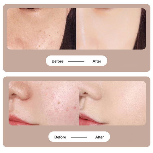 Portable Laser Mole Removal Device with Nine Settings